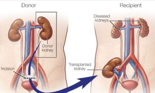 Kidney Transplantation